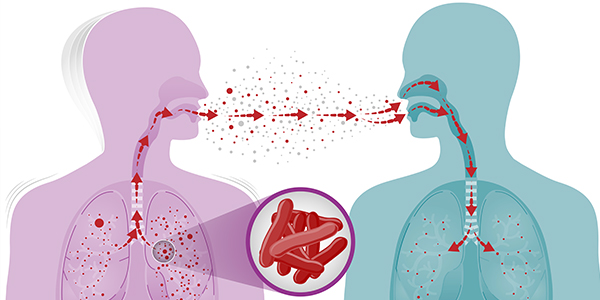 Riverside County resident tests positive for active TB